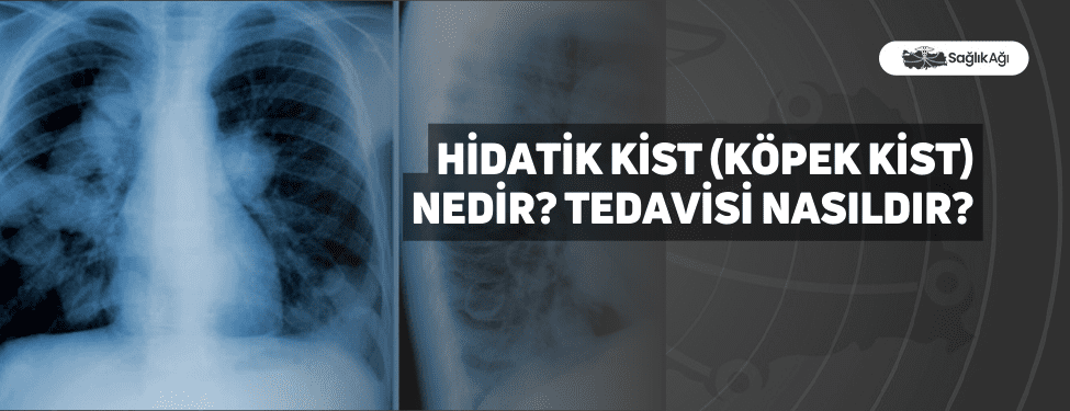 hidatik kist