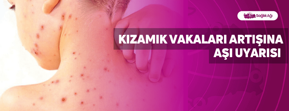 Kızamık Vakaları Artışına Aşı Uyarısı