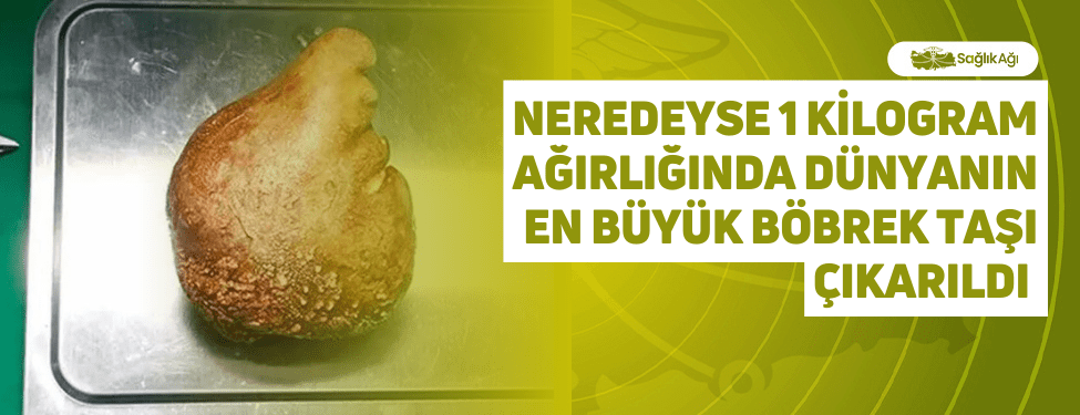 Neredeyse 1 Kilogram Ağırlığında Dünyanın En Büyük Böbrek Taşı Çıkarıldı