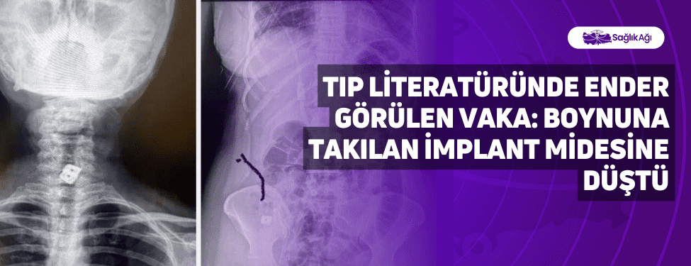 Tıp Literatüründe Ender Görülen Vaka: Boynuna Takılan İmplant Midesine Düştü