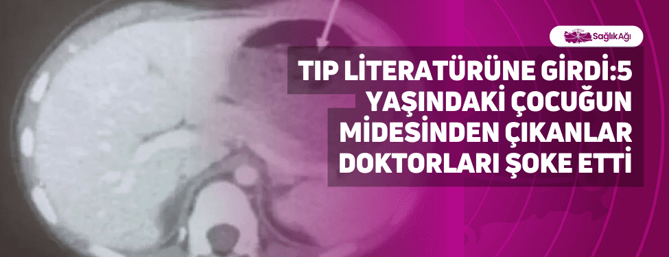 Tıp Literatürüne Girdi:5 Yaşındaki Çocuğun Midesinden Çıkanlar Doktorları Şoke etti