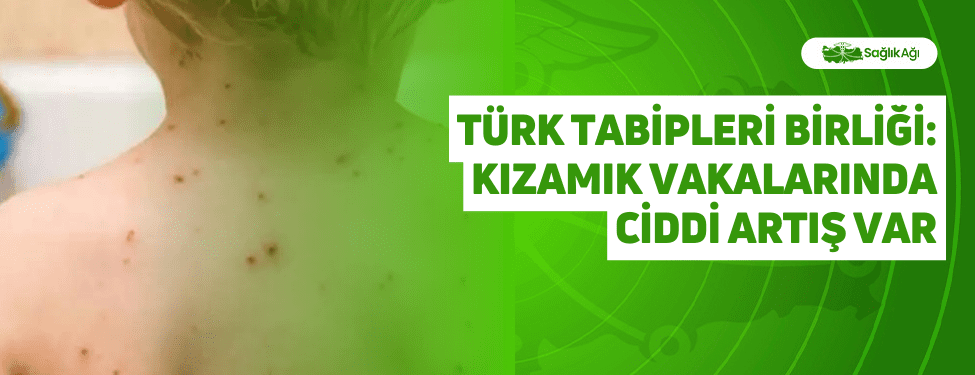Türk Tabipleri Birliği: Kızamık Vakalarında Ciddi Artış Var